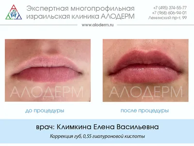 Исправление формы губ «Чайка» 🪶 Губы «Чайка» — это всегда сложная работа  по исправлению формы. .. | ВКонтакте