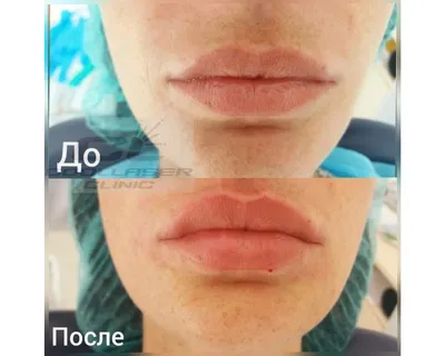 Увеличение губ и изменение формы губ
