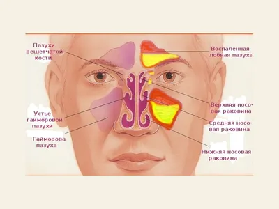 Прокол при гайморите в СПб - сделать пункцию гайморовой пазухи, цены