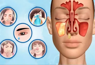 Воспаление гайморовых пазух - диагностика и лечение в 100med