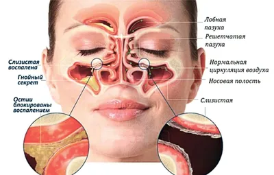 Синус-лифтинг при гайморите - SinusLifting.ru