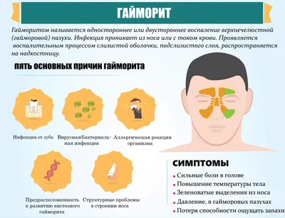 Гайморит - симптомы и лечение в СПб