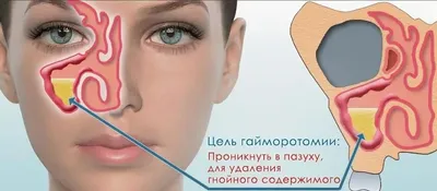 Рак носа: симптомы опухоли носа и гайморовой пазухи | Онкология носовой  полости