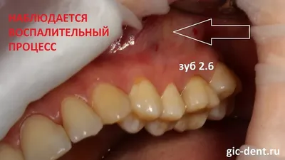 КТ пансинусит | Второе мнение