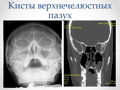 🔻Прокол, или пункция гайморовой пазухи – это метод лечения острого  гнойного гайморита, когда стенку пазухи прокалывают специальной иглой.  Пункцию... | By LOR PLUS Servis | Hair is fourteen