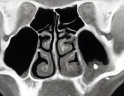 Рентгенография придаточных пазух носа