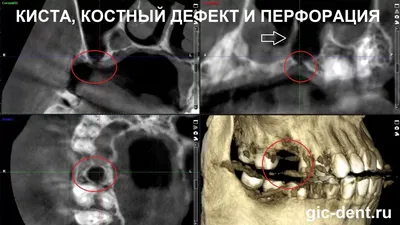 Что показывает компьютерная томография пазух носа, МРТ или КТ носовых и  околоносовых пазух?