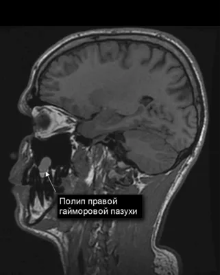 ЛОР-операция: удаление кисты гайморовой пазухи | Частная клиника \"Медик\"  Чебоксары