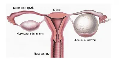 Спайки на яичниках: что это, симптомы, причины, диагностика и лечение