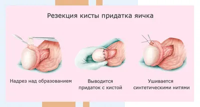 Лечение кисты придатка яичка (эпидидимоцеле) в Москве - цены в клинике  АльтраВита