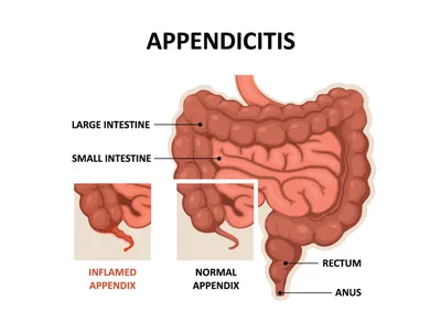 Аппендицит: симптомы у взрослых и детей | Диагностика и лечение аппендицита  в АО «Медицина»
