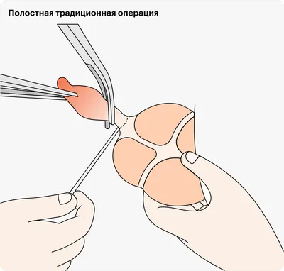 Операция аппендицита (лапароскопическая аппендэктомия) - удаление  аппендицита в Украине