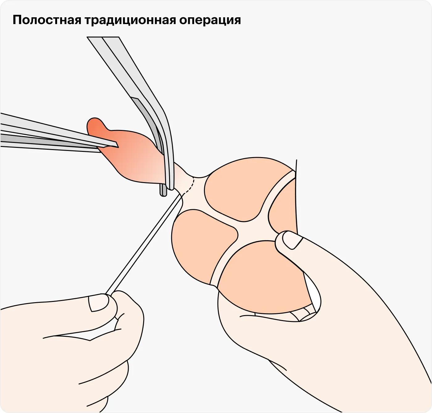 Удаление Аппендицита Цена