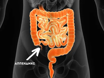 Что такое аппендицит, и нужен ли нам вообще аппендикс?