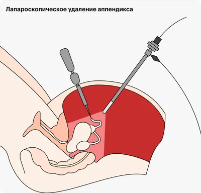 Аппендицит у детей: причины и симптомы, диагностика и лечение в Одессе |  Медицинский дом Odrex