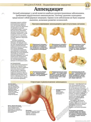 Острый аппендицит: симптомы, признаки, осложнения, диагностика, лечение