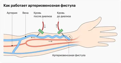 Гемодиализ: что это, как делают и для чего нужен, какую группу инвалидности  дают