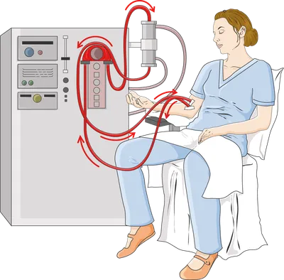Гемодиализ и артериовенозная фистула