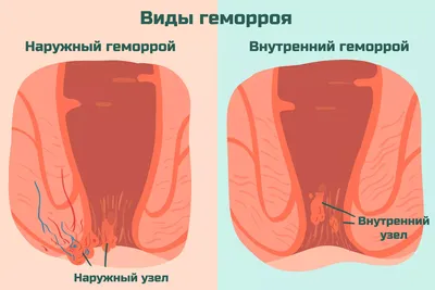 Геморрой у женщин: причины, симптомы, признаки, что делать, как избавиться,  лечение