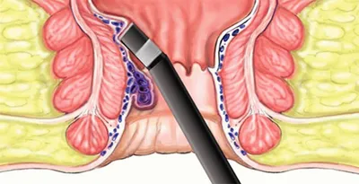 Внутренний геморрой: симптомы, диагностика, лечение - Клиника Доктора  Гришина