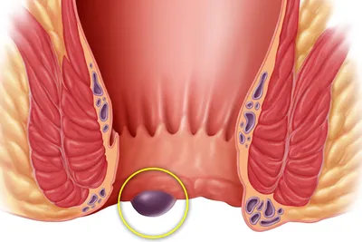 Наружный геморрой: симптомы и методы лечения