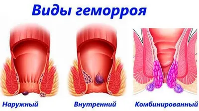 Геморрой: причины, симптомы, диагностика и лечение