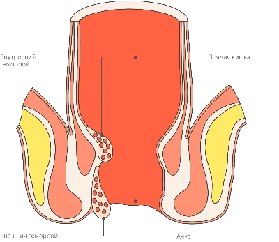 Геморрой: что такое? Как бороться? - статьи от компании Еламед