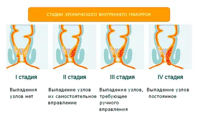 Эффективное лечение геморроя в Ростове-на-Дону