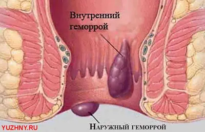 ЛИНИЯ ЖИЗНИ Свечи от геморроя китайские , мускусные.