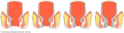 Свечи от геморроя эффективные и недорогие для мужчин и женщин