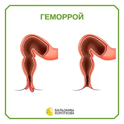 Лечение хронического геморроя в санатории в Кисловодске