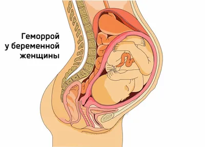 Удаление геморроя - операция под наркозом в Перми | В клинике доступные  цены на операции по удалению геморроя | После удаления геморроя  положительные отзывы | Врачи с большим опытом | Профилактика |