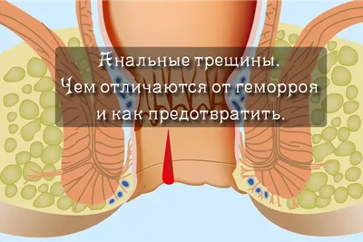 Геморрой симптомы, лечение у женщин и мужчин, какие есть средства,  профилактика