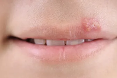 Герпес на губах – лечение лазером
