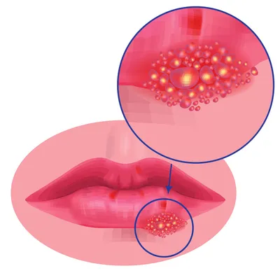 Лечение герпеса в домашних условиях: как быстро избавиться от герпеса дома  народными или аптечными средствами