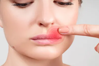 Виды герпеса на лице: в носу, на губах, подбородке и на глазу – симптомы и  как лечить герпес