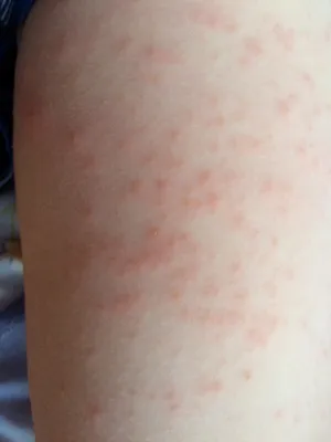 Сыпь на ногах, дерматит стоковое фото ©civic_dm@hotmail.com 156503080