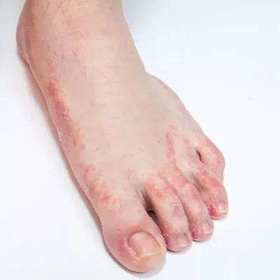 Сыпь на ногах\": европейские врачи нашли новый симптом коронавируса /  VSE42.RU - информационный сайт Кузбасса.