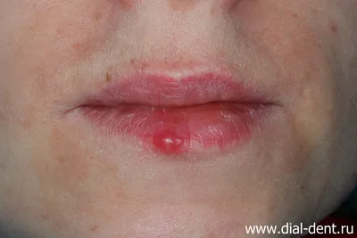 Герпес на губах – лечение лазером