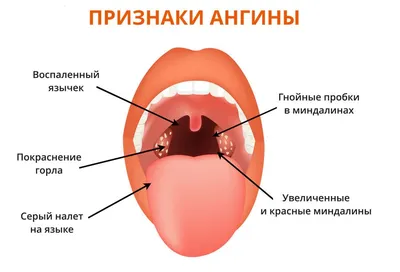 Герпетический стоматит — симптомы, лечение, фото в статье экспертного  журнала Startsmile