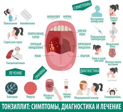 Как проявляется Герпесная ангина?