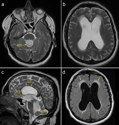 Гидроцефалия головного мозга на МРТ у взрослого - заключение МРТ в клинике  «Союз»