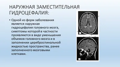 Гидроцефалия головного мозга на МРТ