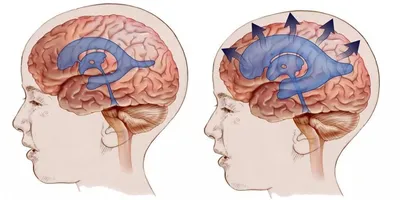 Гидроцефалия мозга: симптомы, лечение в Херсоне | Neuro.ks.ua.