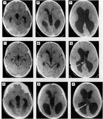 Клинический случай врожденной окклюзионной гидроцефалии у новорожденного  ребенка – тема научной статьи по клинической медицине читайте бесплатно  текст научно-исследовательской работы в электронной библиотеке КиберЛенинка