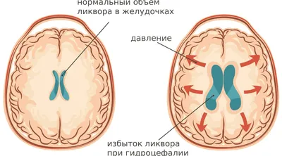 Лечение гидроцефалии головного мозга в Екатеринбурге - Новая Больница