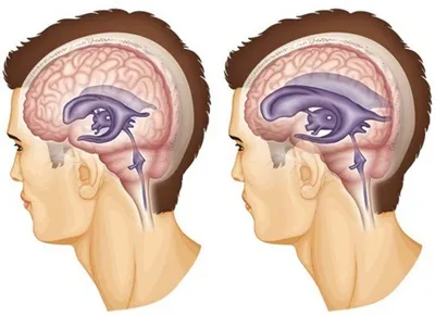 Лечение гидроцефалии. Клинический случай | Пикабу