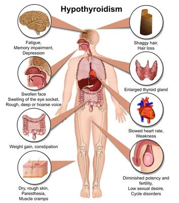 Гипотиреоз - причины, симптомы, признаки, диагностика, анализы, лечение у  женщин, мужчин, детей