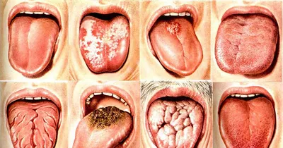 Глоссит языка у детей: симптомы и лечение - SHiFA