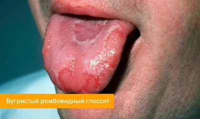 ГАУЗ МО МОСП - 👅Гунтеровский глоссит или глоссит Меллера-Гунтера. Эта  форма болезни является вторичной, так как она указывает на развитие  злокачественной анемии. Сосочки языка становятся гладкими, начинают  отмирать. 👅Язык приобретает малиновый окрас,